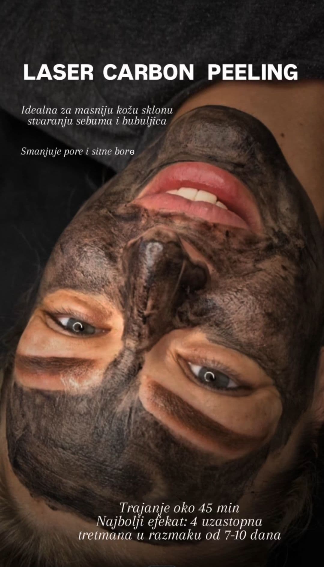 Hollywood peel- Red carpet peel- Karbonski peeling